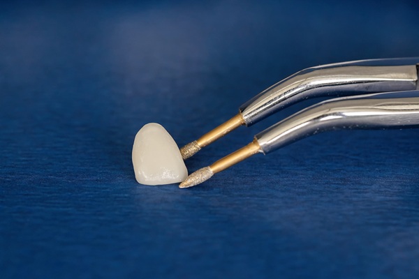 Dental Crowns: Common Issues And How To Address Them